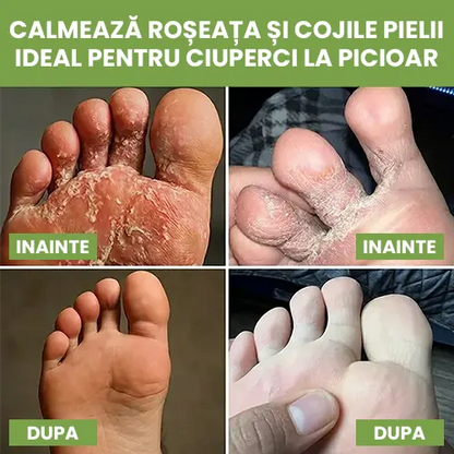 Sapun antifungic - Calmeaza iritatiile si reface bariera naturala a pielii