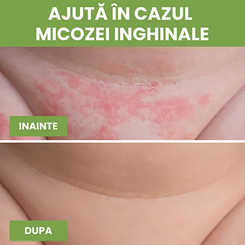 Sapun antifungic - Calmeaza iritatiile si reface bariera naturala a pielii