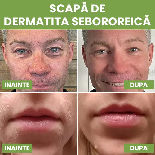 Sapun antifungic - Calmeaza iritatiile si reface bariera naturala a pielii