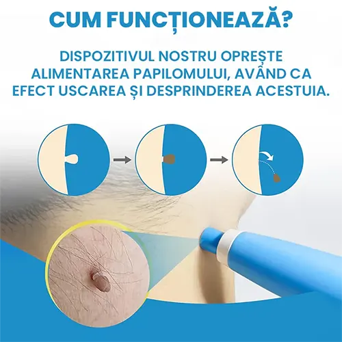 Aparat profesional pentru indepartarea Papiloamelor - potrivit pentru toate tipurile de piele