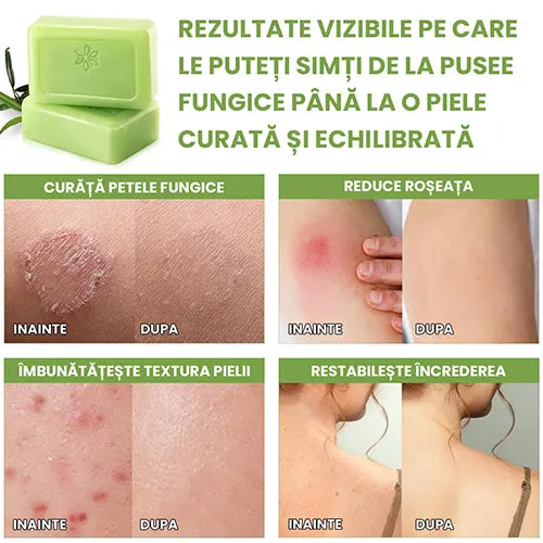 Sapun antifungic - Calmeaza iritatiile si reface bariera naturala a pielii