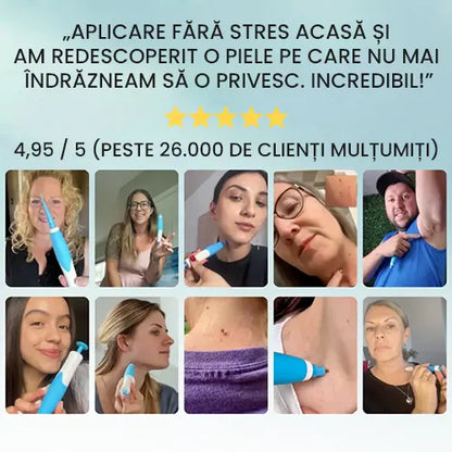 Aparat profesional pentru indepartarea Papiloamelor - potrivit pentru toate tipurile de piele
